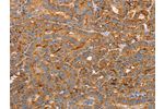 The image on the left is immunohistochemistry of paraffin-embedded Human thyroid cancer tissue using CSB-PA778176(CD59 Antibody) at dilution 1/50, on the right is treated with synthetic peptide. (Original magnification: 