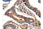 The image on the left is immunohistochemistry of paraffin-embedded Human colon cancer tissue using CSB-PA778289(COX8A Antibody) at dilution 1/12, on the right is treated with fusion protein. (Original magnification: 