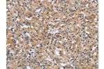 The image on the left is immunohistochemistry of paraffin-embedded Human thyroid cancer tissue using CSB-PA778879(DTNBP1 Antibody) at dilution 1/20, on the right is treated with synthetic peptide. (Original magnification: 