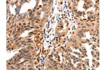 The image on the left is immunohistochemistry of paraffin-embedded Human ovarian cancer tissue using CSB-PA778945(GAS6 Antibody) at dilution 1/10, on the right is treated with synthetic peptide. (Original magnification: 