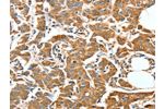 The image on the left is immunohistochemistry of paraffin-embedded Human breast cancer tissue using CSB-PA779355(ALDH9A1 Antibody) at dilution 1/50, on the right is treated with synthetic peptide. (Original magnification: 
