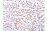 The image on the left is immunohistochemistry of paraffin-embedded Human colon cancer tissue using CSB-PA779568(ANKRA2 Antibody) at dilution 1/50, on the right is treated with synthetic peptide. (Original magnification: 
