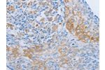 The image on the left is immunohistochemistry of paraffin-embedded Human cervical cancer tissue using CSB-PA779661(ADRB3 Antibody) at dilution 1/60, on the right is treated with synthetic peptide. (Original magnification: 