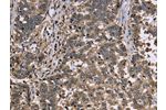 The image is immunohistochemistry of paraffin-embedded Human liver cancer tissue using CSB-PA779821(GAPDH Antibody) at dilution 1/30. (Original magnification: 