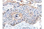 The image on the left is immunohistochemistry of paraffin-embedded Human esophagus cancer tissue using CSB-PA780138(CCNB2 Antibody) at dilution 1/10, on the right is treated with synthetic peptide. (Original magnification: 