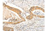The image on the left is immunohistochemistry of paraffin-embedded Human colon cancer tissue using CSB-PA780260(APOB Antibody) at dilution 1/15, on the right is treated with synthetic peptide. (Original magnification: 