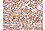 The image on the left is immunohistochemistry of paraffin-embedded Human thyroid cancer tissue using CSB-PA780526(ENDOG Antibody) at dilution 1/15, on the right is treated with synthetic peptide. (Original magnification: 