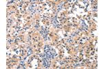 The image on the left is immunohistochemistry of paraffin-embedded Human thyroid cancer tissue using CSB-PA780667(EIF4G1 Antibody) at dilution 1/25, on the right is treated with synthetic peptide. (Original magnification: 