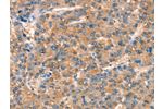 The image on the left is immunohistochemistry of paraffin-embedded Human liver cancer tissue using CSB-PA780716(ARHGAP4 Antibody) at dilution 1/25, on the right is treated with synthetic peptide. (Original magnification: 