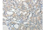 The image on the left is immunohistochemistry of paraffin-embedded Human thyroid cancer tissue using CSB-PA780863(AGAP1 Antibody) at dilution 1/25, on the right is treated with synthetic peptide. (Original magnification: 