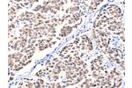 The image on the left is immunohistochemistry of paraffin-embedded Human breast cancer tissue using CSB-PA781017(FBLN1 Antibody) at dilution 1/12, on the right is treated with synthetic peptide. (Original magnification: 