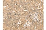 The image on the left is immunohistochemistry of paraffin-embedded Human breast cancer tissue using CSB-PA781114(ATOX1 Antibody) at dilution 1/30, on the right is treated with fusion protein. (Original magnification: 