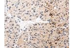 The image on the left is immunohistochemistry of paraffin-embedded Human liver cancer tissue using CSB-PA781210(AQP11 Antibody) at dilution 1/30, on the right is treated with synthetic peptide. (Original magnification: 