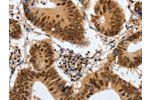 The image on the left is immunohistochemistry of paraffin-embedded Human colon cancer tissue using CSB-PA781273(COPS5 Antibody) at dilution 1/120, on the right is treated with fusion protein. (Original magnification: 