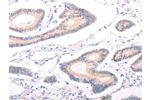 The image on the left is immunohistochemistry of paraffin-embedded Human colon cancer tissue using CSB-PA781903(ABCF3 Antibody) at dilution 1/30, on the right is treated with fusion protein. (Original magnification: 
