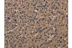 The image on the left is immunohistochemistry of paraffin-embedded Human liver cancer tissue using CSB-PA781905(FGF7 Antibody) at dilution 1/30, on the right is treated with synthetic peptide. (Original magnification: 