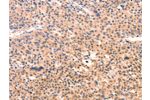 The image on the left is immunohistochemistry of paraffin-embedded Human liver cancer tissue using CSB-PA782005(APBA2 Antibody) at dilution 1/80, on the right is treated with synthetic peptide. (Original magnification: 