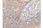 The image on the left is immunohistochemistry of paraffin-embedded Human cervical cancer tissue using CSB-PA782295(ACOT8 Antibody) at dilution 1/15, on the right is treated with fusion protein. (Original magnification: 