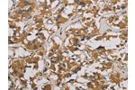The image is immunohistochemistry of paraffin-embedded Human thyroid cancer tissue using CSB-PA782311(CORO1C Antibody) at dilution 1/50. (Original magnification: 