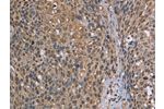 The image on the left is immunohistochemistry of paraffin-embedded Human cervical cancer tissue using CSB-PA782755(CAB39 Antibody) at dilution 1/50, on the right is treated with synthetic peptide. (Original magnification: 