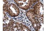 The image on the left is immunohistochemistry of paraffin-embedded Human cervical cancer tissue using CSB-PA783338(DFFA Antibody) at dilution 1/20, on the right is treated with fusion protein. (Original magnification: 