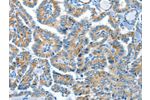 The image on the left is immunohistochemistry of paraffin-embedded Human thyroid cancer tissue using CSB-PA783442(COG1 Antibody) at dilution 1/60, on the right is treated with synthetic peptide. (Original magnification: 