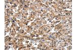The image on the left is immunohistochemistry of paraffin-embedded Human gastic cancer tissue using CSB-PA783700(CTBP1 Antibody) at dilution 1/25, on the right is treated with synthetic peptide. (Original magnification: 