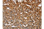 The image on the left is immunohistochemistry of paraffin-embedded Human thyroid cancer tissue using CSB-PA783807(ATP1B2 Antibody) at dilution 1/30, on the right is treated with fusion protein. (Original magnification: 