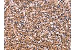 The image on the left is immunohistochemistry of paraffin-embedded Human esophagus cancer tissue using CSB-PA783827(ESRRB Antibody) at dilution 1/40, on the right is treated with synthetic peptide. (Original magnification: 