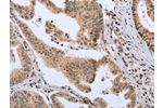 The image on the left is immunohistochemistry of paraffin-embedded Human gastic cancer tissue using CSB-PA783949(DLD Antibody) at dilution 1/20, on the right is treated with fusion protein. (Original magnification: 