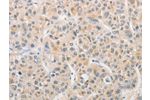 The image on the left is immunohistochemistry of paraffin-embedded Human liver cancer tissue using CSB-PA784037(APLF Antibody) at dilution 1/20, on the right is treated with fusion protein. (Original magnification: 