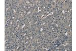 The image on the left is immunohistochemistry of paraffin-embedded Human ovarian cancer tissue using CSB-PA784177(EDN1 Antibody) at dilution 1/30, on the right is treated with fusion protein. (Original magnification: 