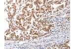 The image on the left is immunohistochemistry of paraffin-embedded Human gastic cancer tissue using CSB-PA784650(CTBP2 Antibody) at dilution 1/25, on the right is treated with fusion protein. (Original magnification: 