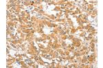 The image on the left is immunohistochemistry of paraffin-embedded Human thyroid cancer tissue using CSB-PA785654(COL4A3BP Antibody) at dilution 1/60, on the right is treated with fusion protein. (Original magnification: 