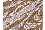 The image on the left is immunohistochemistry of paraffin-embedded Human gastic cancer tissue using CSB-PA785891(DSC2 Antibody) at dilution 1/35, on the right is treated with synthetic peptide. (Original magnification: 