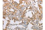 The image on the left is immunohistochemistry of paraffin-embedded Human thyroid cancer tissue using CSB-PA786075(ACTR2 Antibody) at dilution 1/40, on the right is treated with fusion protein. (Original magnification: 