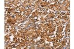 The image on the left is immunohistochemistry of paraffin-embedded Human thyroid cancer tissue using CSB-PA786395(CDC25B  Antibody) at dilution 1/45, on the right is treated with synthetic peptide. (Original magnification: 