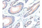 The image on the left is immunohistochemistry of paraffin-embedded Human colon cancer tissue using CSB-PA786632(AADACL2 Antibody) at dilution 1/25, on the right is treated with fusion protein. (Original magnification: 