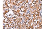 The image on the left is immunohistochemistry of paraffin-embedded Human thyroid cancer tissue using CSB-PA786870(ARC Antibody) at dilution 1/25, on the right is treated with fusion protein. (Original magnification: 