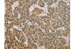 The image on the left is immunohistochemistry of paraffin-embedded Human liver cancer tissue using CSB-PA787197(EHHADH Antibody) at dilution 1/20, on the right is treated with fusion protein. (Original magnification: 
