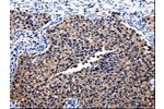 The image on the left is immunohistochemistry of paraffin-embedded Human renal cancer tissue using CSB-PA787438(BID Antibody) at dilution 1/25, on the right is treated with fusion protein. (Original magnification: 