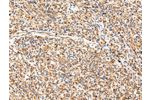 The image on the left is immunohistochemistry of paraffin-embedded Human prostate cancer tissue using CSB-PA787474(ADAMTS1 Antibody) at dilution 1/35, on the right is treated with synthetic peptide. (Original magnification: 