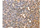 The image on the left is immunohistochemistry of paraffin-embedded Human liver cancer tissue using CSB-PA787484(AFP Antibody) at dilution 1/60, on the right is treated with fusion protein. (Original magnification: 