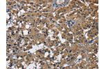 The image on the left is immunohistochemistry of paraffin-embedded Human thyroid cancer tissue using CSB-PA787597(CD160 Antibody) at dilution 1/30, on the right is treated with fusion protein. (Original magnification: 