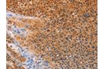 The image on the left is immunohistochemistry of paraffin-embedded Human liver cancer tissue using CSB-PA787644(ADHFE1 Antibody) at dilution 1/30, on the right is treated with synthetic peptide. (Original magnification: 