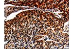 The image is immunohistochemistry of paraffin-embedded Human lung cancer tissue using CSB-PA787659(ALOX5 Antibody) at dilution 1/25. (Original magnification: 