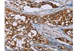 The image on the left is immunohistochemistry of paraffin-embedded Human breast cancer tissue using CSB-PA787876(BMP6 Antibody) at dilution 1/50, on the right is treated with synthetic peptide. (Original magnification: 