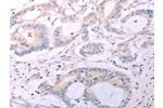 The image on the left is immunohistochemistry of paraffin-embedded Human colon cancer tissue using CSB-PA787914(ACOT2 Antibody) at dilution 1/25, on the right is treated with fusion protein. (Original magnification: 