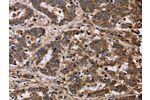 The image on the left is immunohistochemistry of paraffin-embedded Human liver cancer tissue using CSB-PA788032(FH Antibody) at dilution 1/40, on the right is treated with fusion protein. (Original magnification: 