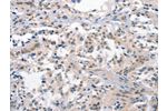 The image on the left is immunohistochemistry of paraffin-embedded Human thyroid cancer tissue using CSB-PA788128(CRHR1 Antibody) at dilution 1/15, on the right is treated with synthetic peptide. (Original magnification: 